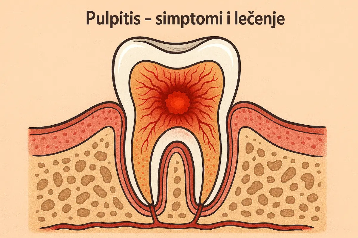 Pulpitis – simptomi i lečenje - Zubar Beograd